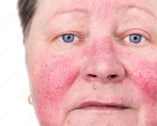 Stress and Your Skin