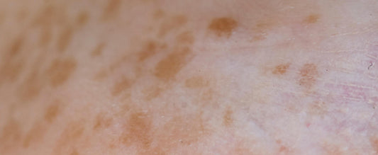 Dark Spots - What are they?